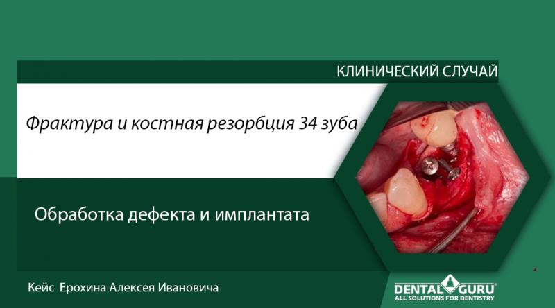 Фрактура и костная резорбция 34 зуба. Обработка дефекта и имплантата