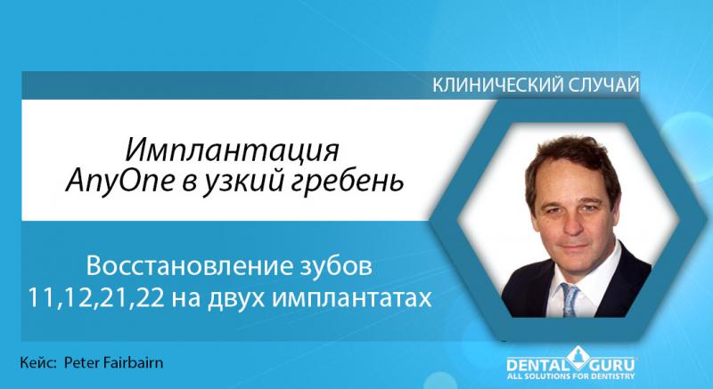 Имплантация AnyOne в узкий гребень. Восстановление зубов 11,12,21,22 на двух имплантатах