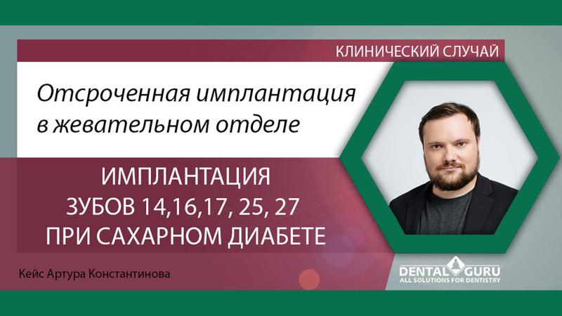 Отсроченная имплантация в жевательном отделе при сахарном диабете. Кейс Артура Константинова