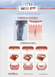 Мини имплантаты Impro - максимальные возможности при минимальных размерах