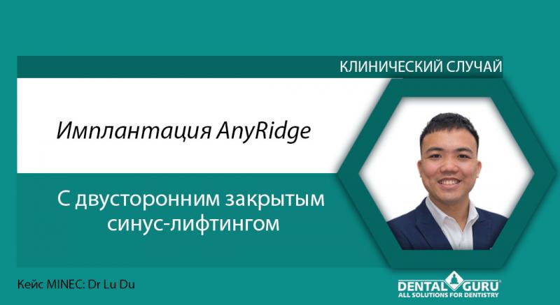 Имплантация AnyRidge с двусторонним закрытым синус-лифтингом