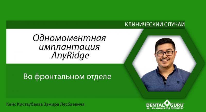 Одномоментная имплантация AnyRidge во фронтальном отделе