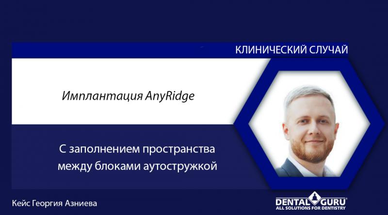 Имплантация AnyRidge с заполнением пространства между блоками аутостружкой