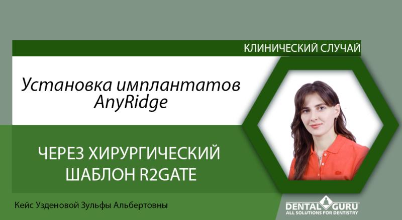 Установка имплантатов AnyRidge через хирургический шаблон R2gate