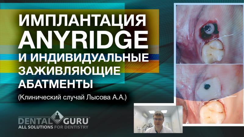 Имплантация AnyRidge и индивидуальные заживляющие абатменты