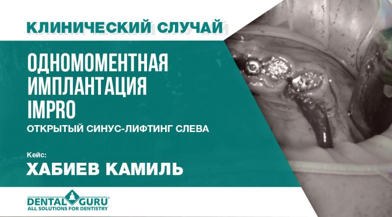 Одномоментная имплантация Impro с проведением синус-лифтинга