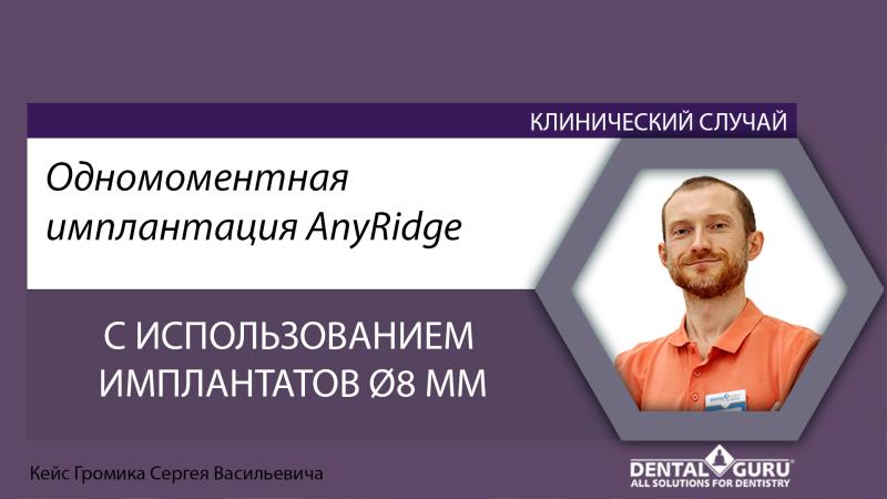 Одномоментная имплантация AnyRidge с использованием имплантатов Ø8 мм. Кейс Громика Сергея