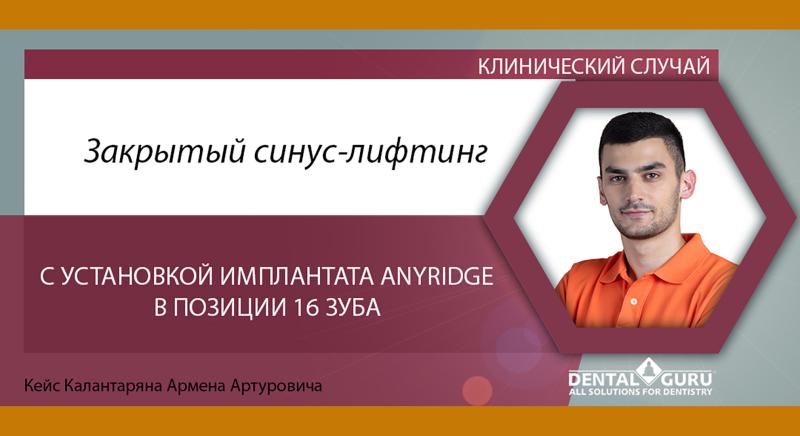 Закрытый синус-лифтинг с установкой имплантата AnyRidge в области 16 зуба. Кейс Армена Калантаряна