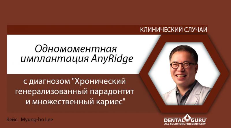 Одномоментная  имплантация AnyRidge с диагнозом "Хронический  генерализованный парадонтит  и множественный кариес"