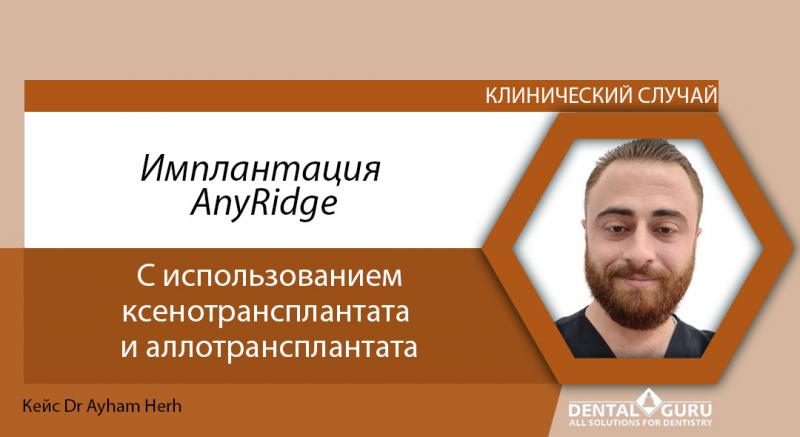 Имплантация AnyRidge c использованием ксенотрансплантата и аллотрансплантата