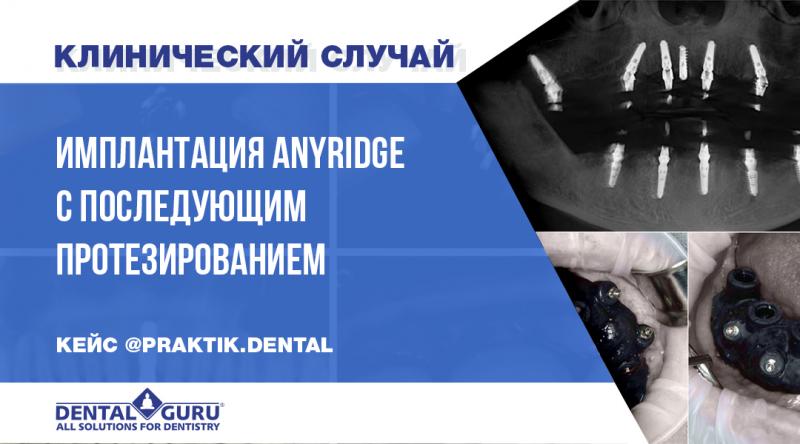 Имплантация AnyRidge с последующим протезированием