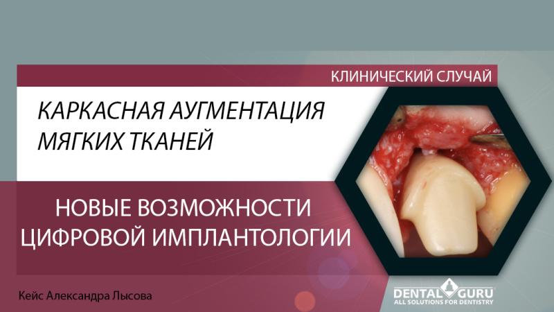 Каркасная аугментация мягких тканей. Клинический случай