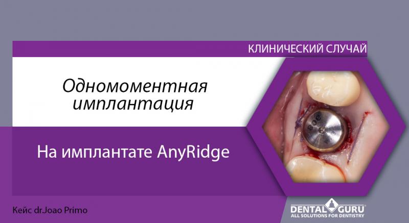 Одномоментная имплантацией AnyRidge