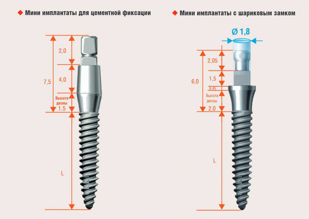 Имплантаты Impro Mini