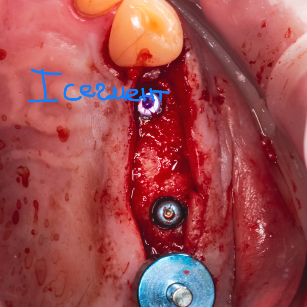 Отсроченная имплантация в жевательном отделе при сахарном диабете. Кейс Артура Константинова