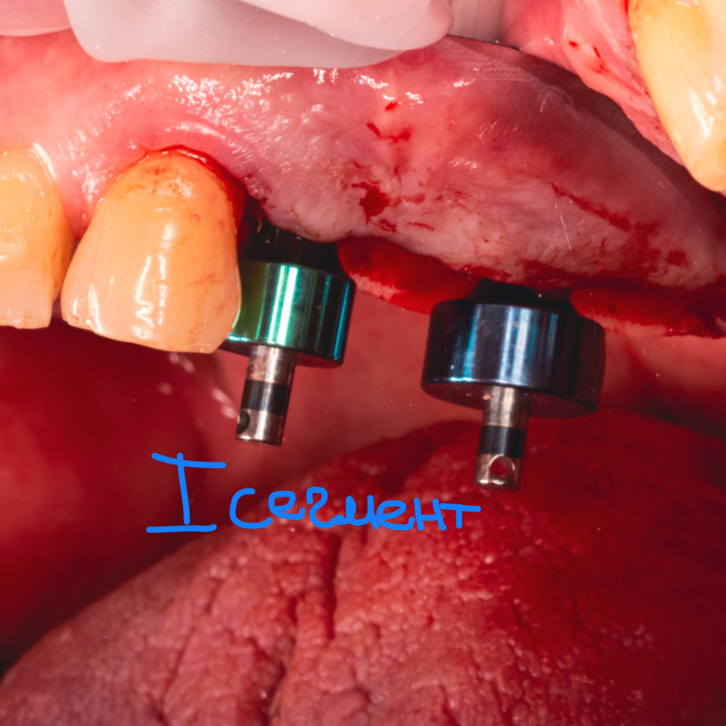 Отсроченная имплантация в жевательном отделе при сахарном диабете. Кейс Артура Константинова