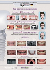 Варианты имплантации Impro