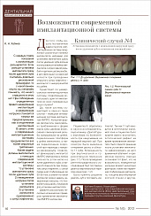 Возможности современной имплантационной системы