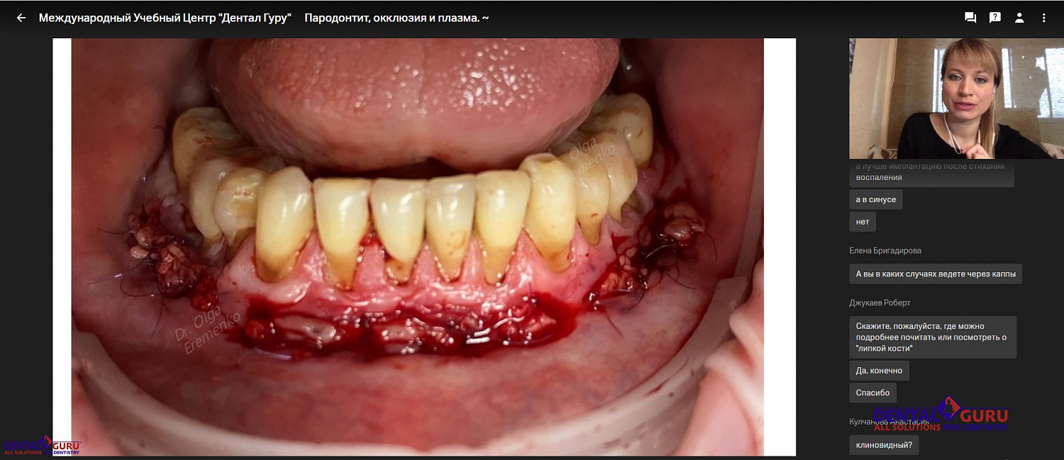 Пост-релиз: Онлайн-курс «Пародонтит, окклюзия и плазма» 29 мая 2020