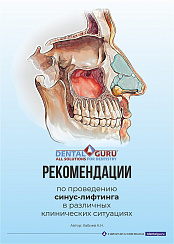 Руководство по проведению синус-лифтинга в различных клинических ситуациях