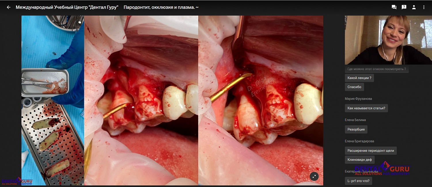 Пост-релиз: Онлайн-курс «Пародонтит, окклюзия и плазма» 29 мая 2020
